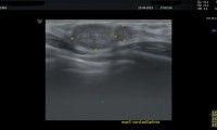 Pat. 43a, spürt Knötchen li Mamma. Befund: gut palpierbares + verschiebbares Knötchen 6mm DM. Medial davon eine Läsion von 18x10mm DM, mit inhomogenen Binnenstrukturen, mit verdächtiger Randstruktur. Stanzbiopsie: bösartig. Zuerst (sogenannte Neo-adjuvante) Chemotherapie. OP 10/19. 2/20:Patientin beschwerdefrei, alle Nachkontrollen ob, Bestrahlung abgeschlossen, nur antihormonelle Therapie. 