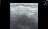 Pat. 35a, 3/16: Schmerzen linke Axilla MG: 2/16: ob. In der Tiefe brustwandnah hoch verdächtiger großer Tumor, in der Mammographie nicht abbildbar gewesen - ad Präoperative - neoadjuvante Chemotherapie-im Anschluss brusterhaltende OP. Sogenannter Triple-negativer (hormonrezeptornegativ, HER2 neu neg) Tumor keine antihormonelle Therapie erforderlich.2/20:Pat. wohlauf,  alle Nachsorgeuntersuchungen ob.