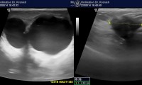 Pat. 46a. 9/14: Pat. spürt verhärtete rechte Brust. Auffällig 2 große Cysten, die Beschwerden rechtfertigen; aber 5cm oberhalb eine hochverdächtige Läsion, durch MRI bestätigt. 3/15: neoadjuvante Chemotherapie. Danach OP. Man erhofft Tumorverkleinerung. OP 1.6.15: Ablatio mamma. abermalige Chemotherapie. 2/16: Lungenmetastasen. 9/16: Patientin stabil unter peroralem Zytostatikum Capecitabin. Proteinkinasehemmer Lapatinib