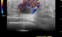 Pat. 37a. 6/2009: 2 Geburten, Farbdoppler Mammasonographie: eindeutig. 1/2013: Patientin beschwerdefrei. Kein Rezidiv.
