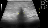 Pat. 76a. 20.1.2015 Mammaographie (MG) verdächtig - auch Ultraschall. OP 2/2015, nach Bestrahlung nur Antihormontherapie.Pat. ist überraschend, plötzlich Herz- + Kreislaufversagen verstorben 10/15.
