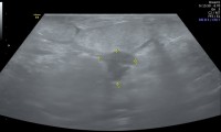 14238 Pat. 45a. MG 3/17: eindeutig bösartig.So auch beim Brustultraschall.Brusterhaltende OP mit nachfolgender Bestrahlung und Antihormoneller Therapie. 