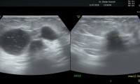 Pat. 56a. Großcystische Mastopathie bekannt. Zwischen den Cysten verdächtige Läsion 12mm. MG unklarer Befund. MRT: bösartig 8/16: brusterhaltende OP. Tumor letzten Endes 7,0x6,3x2,5cm. Bestrahlung. keine Chemotherapie. Antihormonelle Therapie.3/19: Pat wohlauf, Nachsorgekontrollen ob, weiterhin antihormonelle Therapie