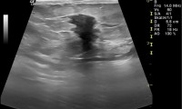 Pat. 64a. 1/15: Pat. ertastet Verhärtung li Brust. Ultraschall: eindeutig + klassisches Beispiel für Brustkrebs. 1/16: Zustand nach Brust erhaltender OP. 2/15, Chemotherapie und Bestrahlung. Dzt. nur Antihormontherapie. Alle Nachsorgebefunde ob.