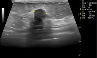 Pat. 69a. seit 6/2007 "ziehen" li brust. alle untersuchungen ohne befund - auch in meiner Ordination. zuletzt 5/2011. 7/2013 Nun beim Radiologen verdächtige Läsion links. Auch bei meiner Untersuchung leider eindeutiger Befund. ad Op. 5/2014: bis dato keine Rückmeldung. 7/2014: Pat geht es nach Chemo + Bestrahlung gut.