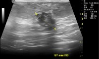 Pat. 75a. mammographisch + sonographisch verifiziert. 1/2014 Patientin beschwerdefrei, kein Rezidiv.