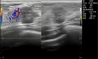 Pat. 44a. ertastet selber Knoten. Ultraschall hochverdächtig, auch in der Mammaographie. 4/2014 unter laufender Therapie Patientin beschwerdefrei, kein Rezidiv.