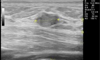 Pat. 47a. ursprünglich Li Mamma verdächtiger Befund. MG:ob NMR: hoch verdächtiger Tumor re!! Mamma.  8/08 brusterhaltende OP mit nachfolgender Bestrahlung und antihormoneller Therapie. 6/2013: unter laufender Therapie Patientin beschwerdefrei. Kein Rezidiv. 2/2014: nach wie vor keine Probleme, so auch 2/20: keine antihormonelle Therapie mehr erforderlich.