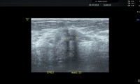 Pat. 49a, beschwerdefrei, Zufallsbefund im Routinescreening. Im Farbdoppler-Brustultraschall hochverdächtige Läsion. Brusterhaltende Operation mit Nachbestrahlung(Irradiatio). 2/20: Pat. beschwerdefrei, alle Nachkontrollen ob, nur Antihormontherapie.