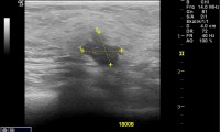 Pat. 45a. Zufallsbefund, Patientin beschwerdefrei. Hochverdächtige Raumforderung, auch in Mammographie + Magnetresonanz. Histo: bösartig. Brusterhaltende OP mit nachfolgender Bestrahlung. 10/2013: Patientin unter laufender Therapie beschwerdefrei. Kein Rezidiv. 2/19 nach 10 Jahren - keine antihormoneller Therapie mehr erforderlich. beschwerdefrei.