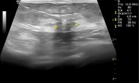 Pat. 75a. 6/15 MG Befund BIRADS 0 = unklarer Befund, ad MRT 21.12.15: beim heutigen Brustultraschall nicht unverdächtiger Herdbefund. 2/16 MRT: verdächtig 3/16: Mammacarcinom Operation. Günstige Prognose 12/16 und 2/20:  Pat wohlauf, nur Antihormontherapie