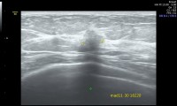 Pat. 63a, 10/15: Mammographie ob. Brustultraschall verdächtige 8mm kleine Läsion 5/16: brusterhaltende OP, Bestrahlung, Antihormontherapie.5/19:alle Nachkontrollen ob, weiterhin nur antihormonelle Therapie