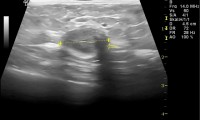 Pat. 68a. 2000: linksseitige Brustkrebs-Op. Nun in der rechten Brust vom Aspekt her bösartiger Befund. ad OP: neuroendokriner Tumor (NET),triple-negatives,G1-G2,pT1c,pN0sn(0/4)