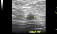 Pat. 46a. Mammographie verdächtig, so auch Ultraschall. 1/2014: Patientin wohlauf. Kein Rezidiv.