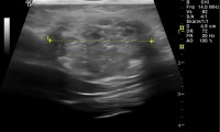 Pat. 64a. 2/2012 spürt Knoten linke Mamma. Farbdoppler-Brustultraschall verdächtige 16mm Läsion. Patientin geht nicht zum Radiologen, kommt auch nicht zur Kontrolle. 8.7.2013 Tumor hat eine Größe von 32mm. ad Op. 2/2014: Patientin hat OP, Chemotherapie,  Bestrahlung gut toleriert.