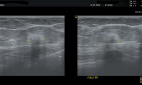 Pat. 74a, bei Mammographie nur Asymmetrie. Farbdopplerultraschall höchst verdächtige Läsion.Pat. wurde operiert, nur Antihormontherapie.2/20: Patientin wohlauf, alle Nachkontrollen ob, weiterhin nur antihormonelle Therapie.