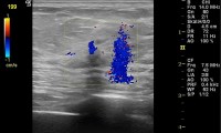 Pat. 71a. Mammographie: 7mm große Läsion, Farbdoppler-Brustultraschall: pathologisch dickes Gefäß, NMR: Intensive Kontrastmittel-Aufnahme. Brusterhaltende OP 2.8.2007 mit nachfolgender Bestrahlung und Antihormotherapie 6/2013: Patientin unter laufender Therapie beschwerdefrei. Kein Rezidiv. 4/19: Pat. beschwerdefrei, alle Nachuntersuchungen ob.