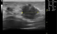 Pat. 42a. 8.6.2010 spürt Knoten. Zweitmeinung. bösartig, ad brusterhaltende OP.  6/2014 Patientin geht es sehr gut. 2/20:nach 9 Jahren antihormonelller Therapie beschwerdefrei.