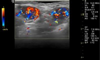 Pat. 43a. 2007 Quadrantenresektion li Brust, nun erneut Rezidiv, Biopsie gutartig. trotzdem Op: bösartig. 2/2014: Chemotherapie pausiert(Lymphknotenmetastasen im Lungen-CT)