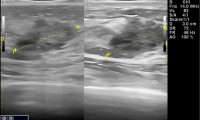 Pat. 69a. 5/2009 Mammographie und Sonographie ob. 9/2010 Brustultraschall ob. 5/2011: Farbdoppler-Brustultraschall eindeutig, ad OP. 10/2013 Patientin beschwerdefrei. Kein Rezidiv.