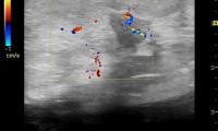 Pat. 58a. 4/2009: spürt "Dippel" in der Brust. Farbdoppler bösartiger Befund. 6/09: brusterhaltende OP mit Nachbestahlung.4/2014: Patientin unter laufender antihormoneller Therapie beschwerdefrei. Kein Rezidiv.2/20: Pat. unter laufender antihormoneller Therapie beschwerdefrei.