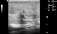 Pat. 57a. Erstkonsultation. Mammographie + Ultraschall auswärts ob. "mammographisch "stummes" Mammacarcinom. Farbdoppler-Brustultraschall: höchst verdächtige Läsion. Histo: bösartig. 9/19 brusterhaltende OP mit nachfolgender Bestrahlung. 4/2014: unter laufender antihormoneller Therapie Patientin beschwerdefrei. Kein Rezidiv. 11/19: alle Nachkontrollen ob, nach 10 Jahren keine antihormonelle Therapie mehr erforderlich.