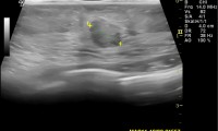 Pat. 56a. spürt Ziehen in der linken Brust. Brustultraschall: Nicht unverdächtiger Aspekt. Auch mammographisch verifiziert. 4/2013: Patientin unter laufender Therapie beschwerdefrei. Kein Rezidiv. 6/2014 weiterhin beschwerdefrei