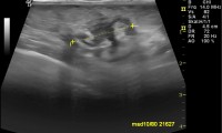 Pat. 43a. 2/2015: beschwerdefreie Patientin. Bei der Farbdoppler-Mammasonographie hoch verdächtige Läsion. 3/2015 Brust erhaltende Operation, Bestrahlung. 6/16. Pat. wohlauf - Chemotherapie im Laufen. Ansonst alle Befunde im Rahmen der Nachsorge ob