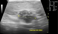 Pat. 58a. 10.8.2011: sogenannter mammographisch stummer Brustkrebs.  MG: 3/2011: ob. heute ausgedehnter bösartiger befund. ad Op. 1/2014 Patientin unter laufender Therapie beschwerdefrei. Kein Rezidiv