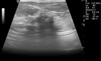 Pat. 80a. spürt Knoten in der Brust. Auch mammographisch nachvollziehbar. 10/2012 Patientin unter laufender Therapie beschwerdefrei. Kein Rezidiv. 6/2014: nach wie beschwerdefrei.