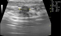 Pat. 49a. In der Mammographie neu aufgetretene Läsion. Auch im Farbdoppler-Brustultraschall bösartiger Aspekt. ad Op