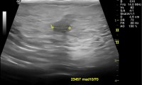 Pat. 33a. MG BIRADS:4 Brustultraschall: nicht unverdächtige Läsion 8.4mm. OP bösartig mit nachfolgender Chemo. 2/20:Patientin wohlauf nur Antihormontherapie