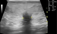 Pat. 54a. 2007: QUART Mammae dext. 4/14: MG BIRADS 4b. 4/14 Mammasonographie höchst verdächtiger Hinweis auf Rezidiv rechte Mamma. Aber: Überraschung! Op: gutartig!