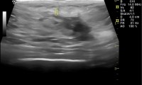 Pat. 45a., Spürt seit einer Woche Knoten. Eindeutig bösartiger Aspekt. Letzte MG vor 2 Jahren. Biopsie: bösartig. Neoadjuvante Chemo danach 8/16 brusterhaltende OP.  2/20: Pat. wohlauf, alle Nachuntersuchungen ob, nur Antihormonelle Therapie,