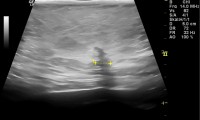 pat. 71a. in der Mammographie entdeckt, im Ultraschall nach längerem Suchen nachvollziehbar. 3/2014: Patientin beschwerdefrei. Kein Rezidiv