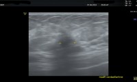 25218Pat. 62a,  bei Mammographie unklarer Befund. Im Farbdoppler höchst verdächtige Aspekt. Auch MRT bösartiger Befund. Nach präoperativer (neoadjuvanter) Chemotherapie erfolgreiche, brusterhaltende OP 1/20. AdBestrahlung. Antihormonelle Thrapie für 5 Jahre geplant.2/20:Pat.wohlauf.