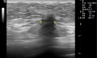 Pat. 62a. Beschwerdefrei. Mammographie 7/09: ob. 3/10: Brustkrebs. "mammographisch stumm" - bei Mammographie nicht erkennbarer Brustkrebs. 3/10: brusterhaltende OP mit nachfolgender Bestahlung und antihormoneller Thrapie. 5/2014 unter laufender Therapie beschwerdefrei, kein Rezidiv.  2/20: Pat. unter laufender antihormoneller Therapie beschwerdefrei, alle Nachkontrollen ob.