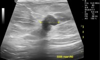 Pat. 54a. Mammographie verdächtig. auch Ultraschall. Op: bösartig. 7/2013: Pat. unter laufender Therapie wohlauf. Kein Rezidiv. 7/2014 nach wie vor keine Probleme