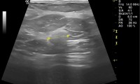 Pat. 50a. 8/2013: in der MG wolkiges Gewebsareal BIRASDS:0 (keine definitive Beurteilung möglich) Auch beim Farbdoppler-Brustultraschall völlig atypisch hellere Läsion 11 mm Durchmesser. 11/13: MRI-bösartig. 14.11.2013 Biospie bösartig. ad OP. 5/2014 gute Prognose. Komplikation: Strahlendermatitis