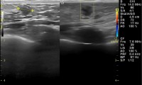 Pat. 56a. 12/14: Mammaographie verdächtig, auch im Brustultraschall. Unterschiedliche Darstellung der Läsion. 1/15:  Brust erhaltende OP. 1/16: Zustand nach Chemotherapie und Bestrahlung. Keine Antihormontherapie. Alle Nachsorgeuntersuchungen ob.