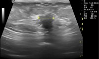 Pat. 43a. Mammographie 6/2012 bösartig. auch Ultraschall. 7/2012: OP + Bestrahlung. Keine Chemotherapie. 7/2013: unter laufender antihormoneller Therapie ist die Patientin beschwerdefrei, so auch 2/2015.   2/2020:Pat. wohlauf, alle Nachkontrollen ob, derzeit keine Therapie mehr notwendig
