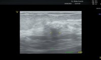 Pat. 74a, 6/16: MG hoch verdächtiger Befund. Auch im Brustultraschall 8mm kleine verdächtige Läsion. 7/16: brusterhaltende OP, nur Antihormontherapie und Bestrahlung- 2/20:Pat.wohlauf, alle Nachkontrollen ob. Nur Antihormontherapie.
