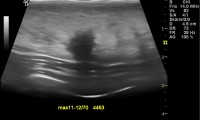 Pat. 37a. beschwerdefrei. 10.8.2011: höchst verdächtiger Befund, OP:bösartig. 4/2014 Patientin unter laufender Therapie wohlauf. Kein Rezidiv.