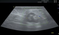 Pat. 72a, letzte MG und Brustultraschall 10/15. Spürt Knoten in der Brust. Brustultraschall hochverdächtig - auch in der nachfolgenden Mammographie. Ad Neoadjuvante Chemo, nachfolgend war brusterhaltende OP möglich. 7/19: Pat. wohlauf, nur Antihormonthrapie.