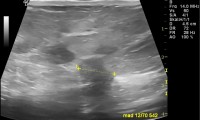 Pat. 49a. Routinemammographie: verdächtig. auch Ultraschall. Op: bösartig. 1/2014 Patientin wohlauf. Kein Rezidiv