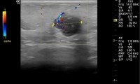 Pat. 81a. spürt beim Duschen einen Knoten. Mammographie: bösartig, so auch im Ultraschall. 10/2013: Patientin beschwerdefrei, kein Rezidiv.