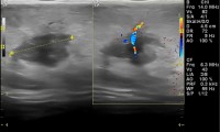 Pat. 41a. spürt Schwellung in der Brust. Farbdoppler-Brustultraschall: eindeutig bösartiger Befund: Mammographie: auch bösartiger Befund. ad OP. 9/2013 Patientin unter laufender Therapie beschwerdefrei. Kein Rezidiv