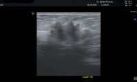 81 jährige Patientin spürt Knoten. Brustultraschall: bösartig. Brusterhaltende Operation, keine Chemo.Nur antihormonelle Therapie