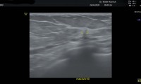 80 jährige Patientin, 1992 wegen Ductales Carcinoma in situ (sogenanntes DCIS, noch keine invasiver Brustkrebs) der rechten Brust operiert. Nun in der linken Brust in der MG unscharf begrenztes Areal. Im FGarbdoppler-Brustultraschall minimale Strukturalteration mit Gewebsarchitekturstörung. Brusterhaltende OP, keine Cheno, nur antihormonelle Therapie