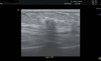 68 jährige Patientin, unscharf begrenzte, inhomogener Tumor mit Schallauslöschung, brusterhaltende Operation, nur antihormonelle Therapie,